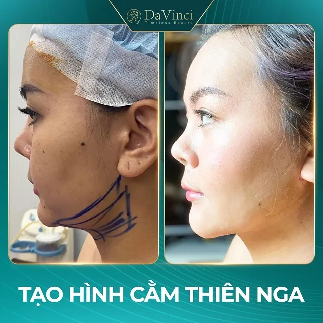 Quy trình và đối tượng tạo hình cằm thiên nga Quy trình và đối tượng tạo hình cằm thiên nga