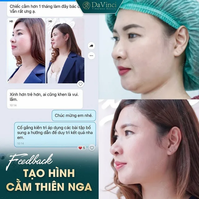 Quy trình và đối tượng tạo hình cằm thiên nga Quy trình và đối tượng tạo hình cằm thiên nga