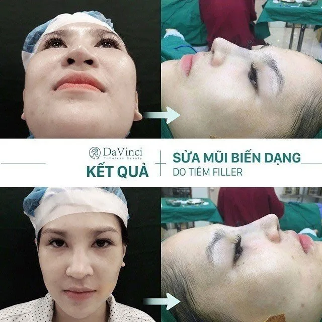 Sửa mũi bị lỗi hỏng ở đâu an toàn uy tín tại Hà Nội và TP Hồ Chí Minh