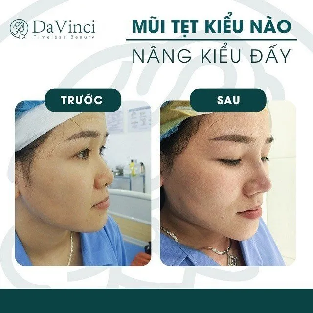 Sửa mũi bị lỗi hỏng ở đâu an toàn uy tín tại Hà Nội và TP Hồ Chí Minh