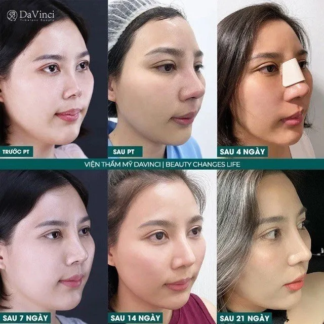 Sửa mũi bị lỗi hỏng ở đâu an toàn uy tín tại Hà Nội và TP Hồ Chí Minh