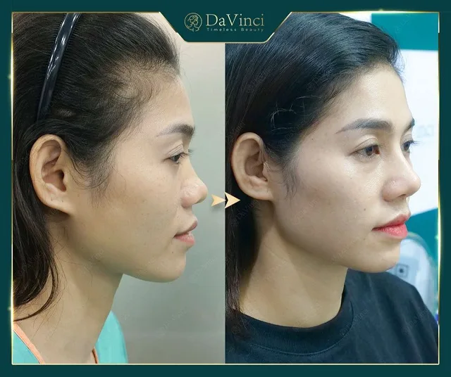 Sửa mũi bị lỗi hỏng ở đâu an toàn uy tín tại Hà Nội và TP Hồ Chí Minh