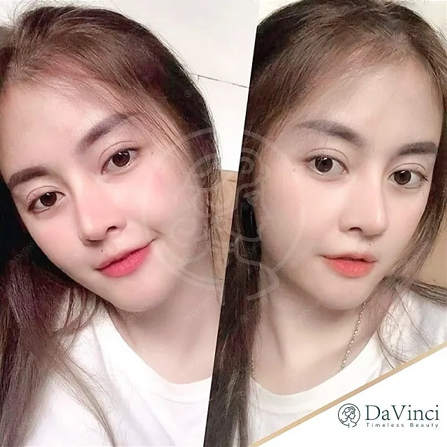Sửa mũi bị lỗi hỏng ở đâu an toàn uy tín tại Hà Nội và TP Hồ Chí Minh