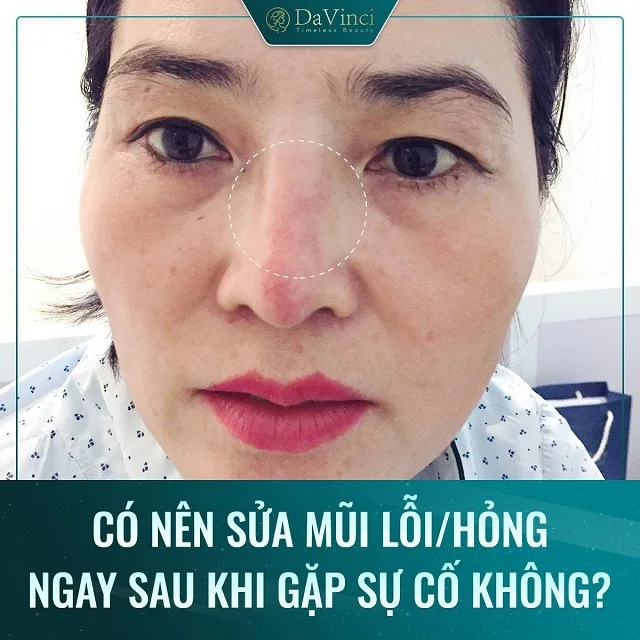 Sửa mũi bị lỗi hỏng ở đâu an toàn uy tín tại Hà Nội và TP Hồ Chí Minh
