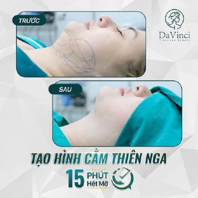 Tạo hình cằm thiên nga là gì? Tạo hình cằm thiên nga có tốt không? Tạo hình cằm thiên nga là gì? Tạo hình cằm thiên nga có tốt không?