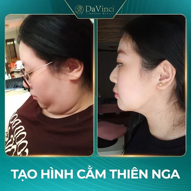 Tạo hình cằm thiên nga là gì? Tạo hình cằm thiên nga có tốt không? Tạo hình cằm thiên nga là gì? Tạo hình cằm thiên nga có tốt không?