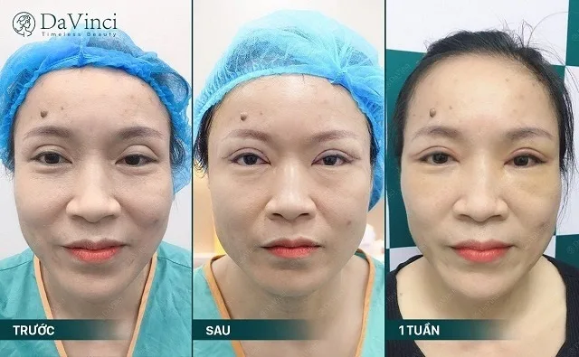 Cắt mí mắt có ĐAU không? Top những phương pháp giảm đau hiệu quả