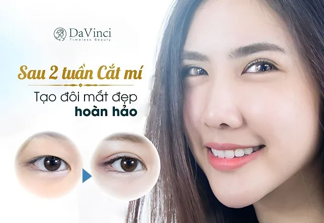 Cắt mí mắt có ĐAU không? Top những phương pháp giảm đau hiệu quả