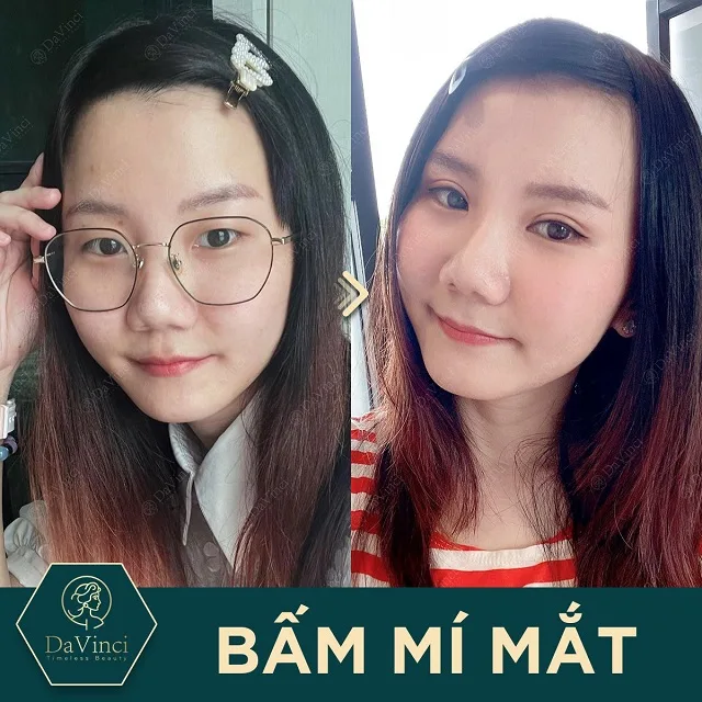 Mắt 1 mí nên cắt mí hay nhấn mí? Sự khác biệt giữa nhấn mí và cắt mí Mắt 1 mí nên cắt mí hay nhấn mí? Sự khác biệt giữa nhấn mí và cắt mí