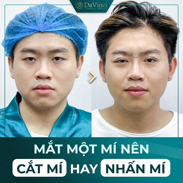 Mắt 1 mí nên cắt mí hay nhấn mí? Sự khác biệt giữa nhấn mí và cắt mí Mắt 1 mí nên cắt mí hay nhấn mí? Sự khác biệt giữa nhấn mí và cắt mí