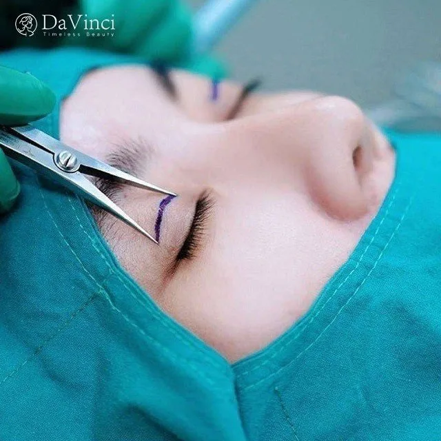 Mắt 1 mí nên cắt mí hay nhấn mí? Sự khác biệt giữa nhấn mí và cắt mí Mắt 1 mí nên cắt mí hay nhấn mí? Sự khác biệt giữa nhấn mí và cắt mí