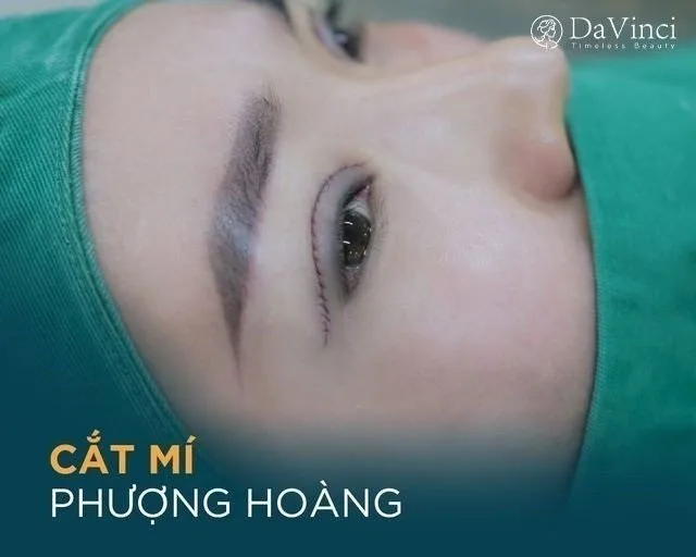 Mắt 1 mí nên cắt mí hay nhấn mí? Sự khác biệt giữa nhấn mí và cắt mí Mắt 1 mí nên cắt mí hay nhấn mí? Sự khác biệt giữa nhấn mí và cắt mí