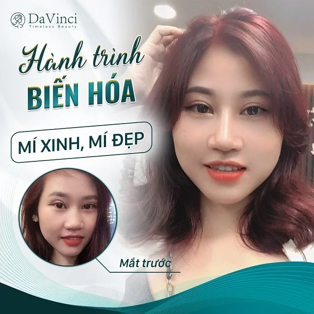 Cắt mí mắt ăn sầu riêng được không? Kiêng trong bao lâu? Cắt mí mắt ăn sầu riêng được không? Kiêng trong bao lâu?