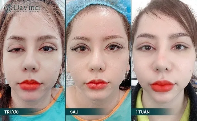 Cắt mí mắt bao lâu thì lành, hết sưng và đẹp tự nhiên? 
