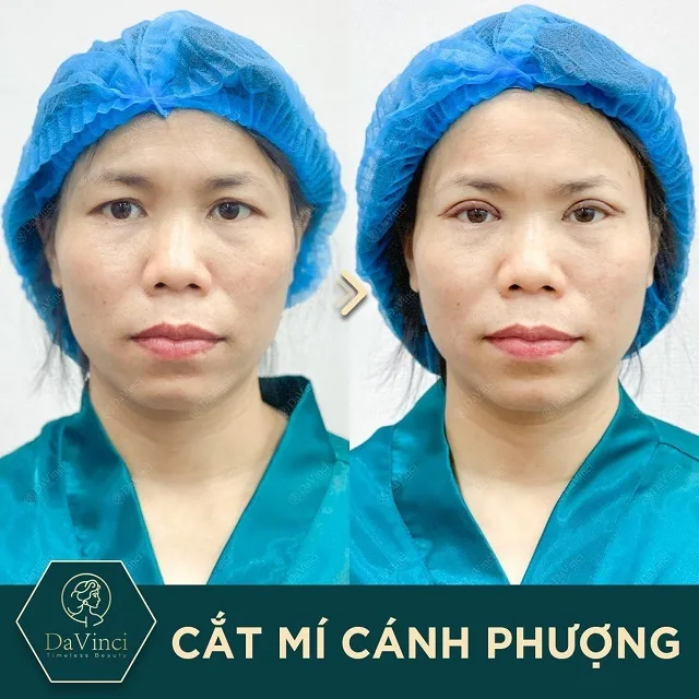 Cắt mí mắt bao lâu thì lành, hết sưng và đẹp tự nhiên? 
