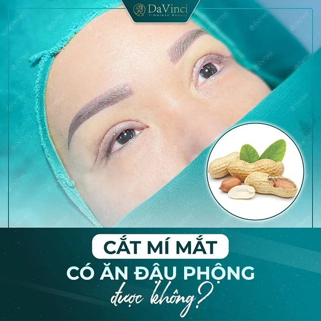 Cắt mí mắt có ăn đậu phộng được không? Cắt mí mắt có ăn đậu phộng được không?