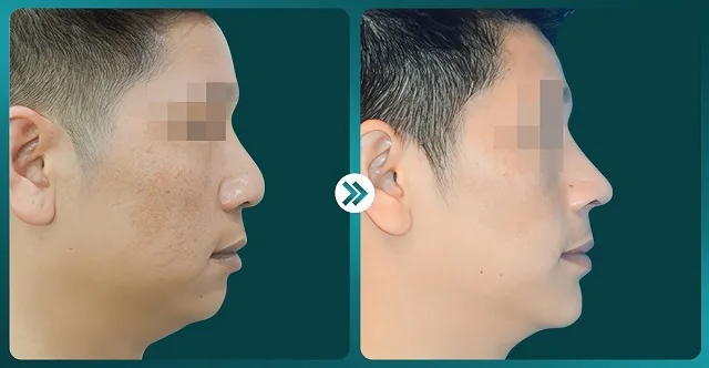 Cằm ngắn là gì? Cách khắc phục cằm tròn hiệu quả nhất!