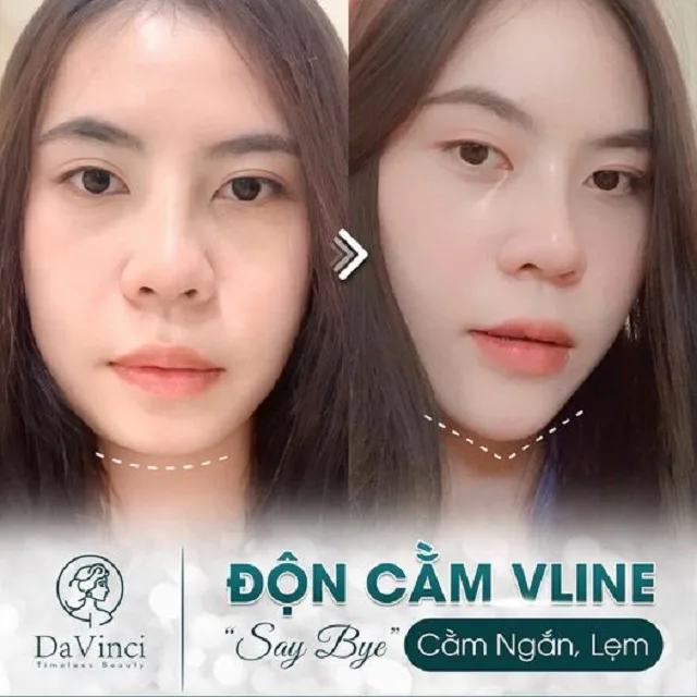 Cằm ngắn là gì? Cách khắc phục cằm tròn hiệu quả nhất!