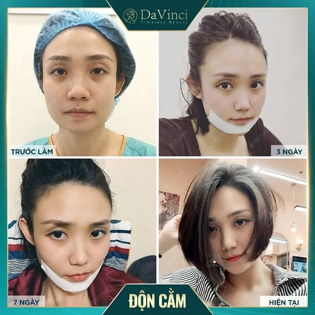 Cằm ngắn là gì? Cách khắc phục cằm tròn hiệu quả nhất!