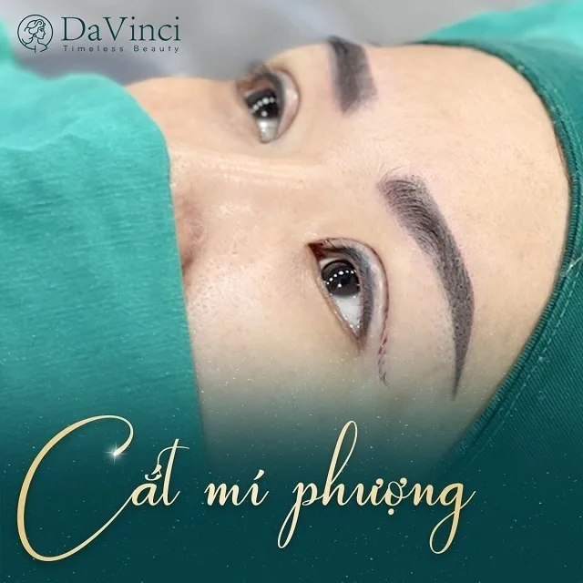 Cắt mí bao lâu hết sưng, lành đẹp tự nhiên? 