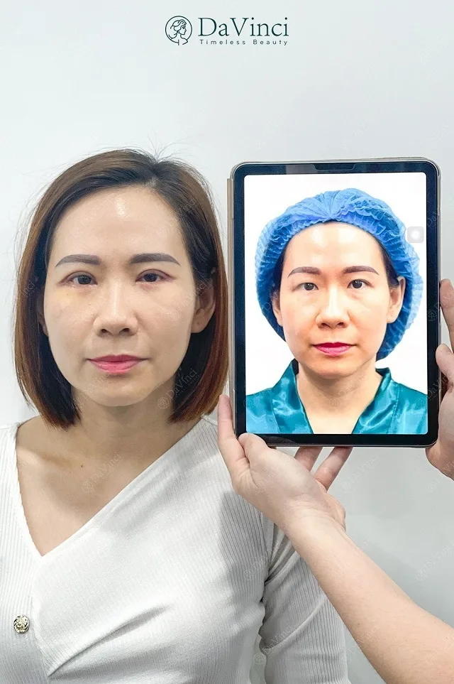 Cắt mí bao lâu hết sưng, lành đẹp tự nhiên? 
