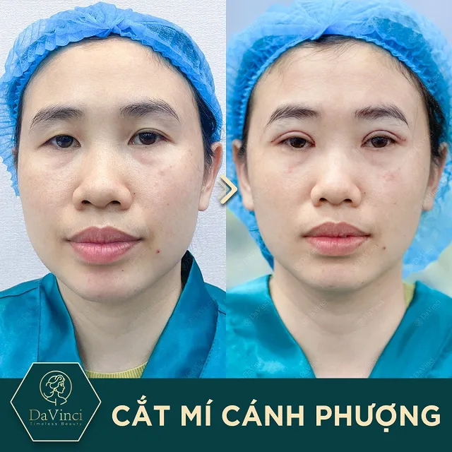 Cắt mí bao lâu hết sưng, lành đẹp tự nhiên? 