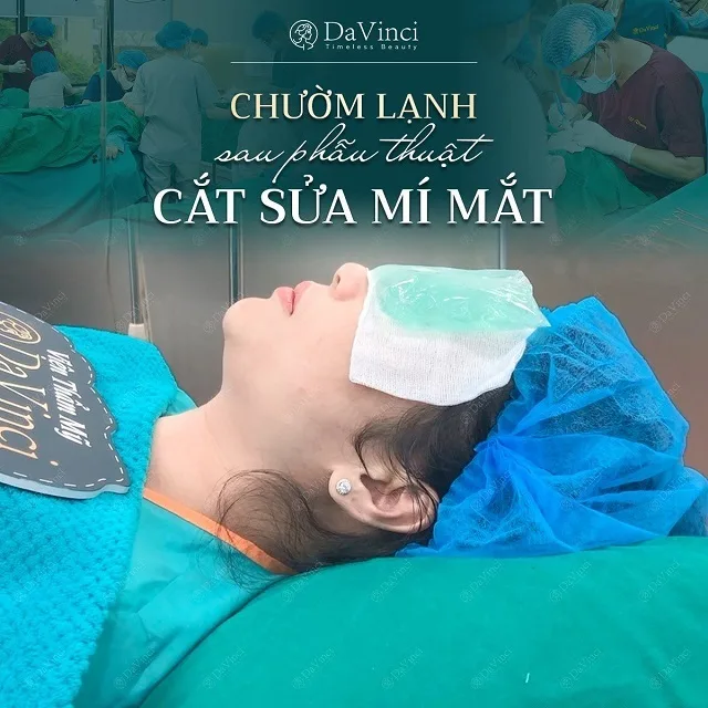 Cắt mí bao lâu hết sưng, lành đẹp tự nhiên? 