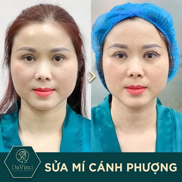 Cắt mí bao lâu thì cắt chỉ? Cắt mí mắt có ảnh hưởng gì không?