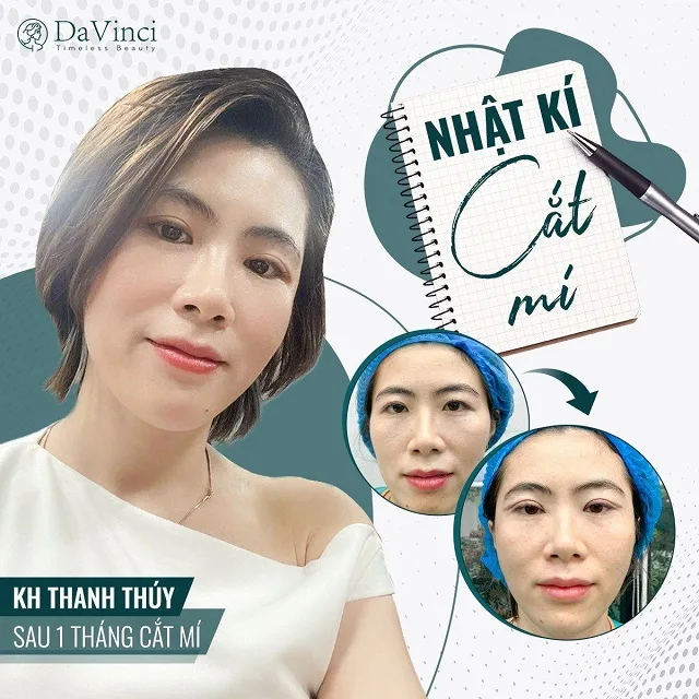 Cắt mí mắt có ăn được thịt vịt không? Cần kiêng bao lâu?