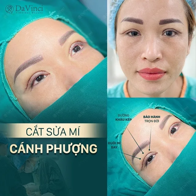 Cắt mí mắt kiêng đồ nếp bao lâu để mí đẹp và không bị sẹo lồi?