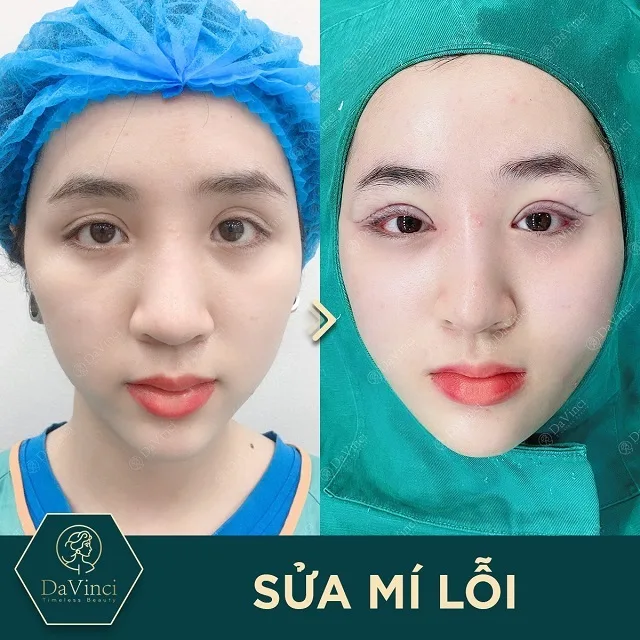 Cắt mí mắt kiêng đồ nếp bao lâu để mí đẹp và không bị sẹo lồi?