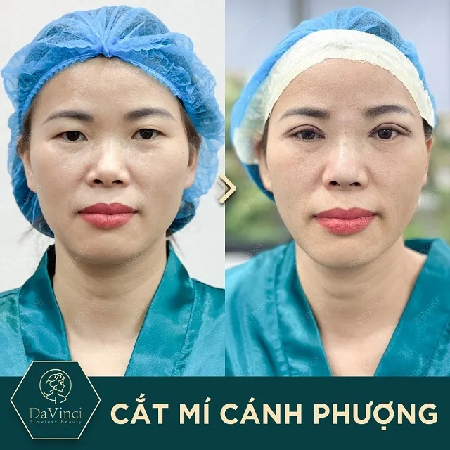 Cắt mí mắt có để lại sẹo không? Chia sẻ cách tránh sẹo sau khi cắt mí mắt?