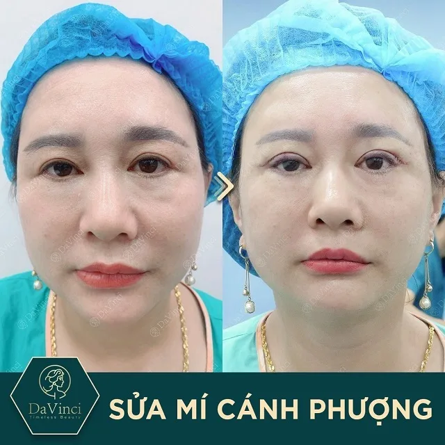 Cắt mí mắt có để lại sẹo không? Chia sẻ cách tránh sẹo sau khi cắt mí mắt?