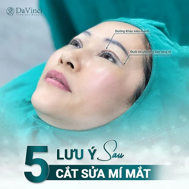 Cắt mí mắt bị sẹo lồi phải làm sao? Nguyên nhân và cách khắc phục 