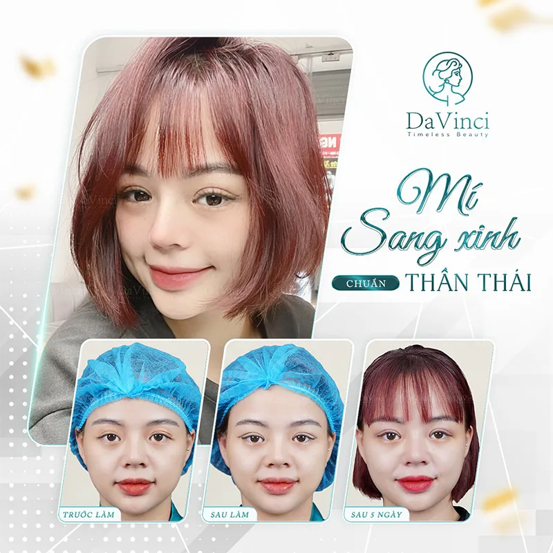 Cắt mí mắt bị sẹo lồi phải làm sao? Nguyên nhân và cách khắc phục hiệu quả Cắt mí mắt bị sẹo lồi phải làm sao? Nguyên nhân và cách khắc phục hiệu quả
