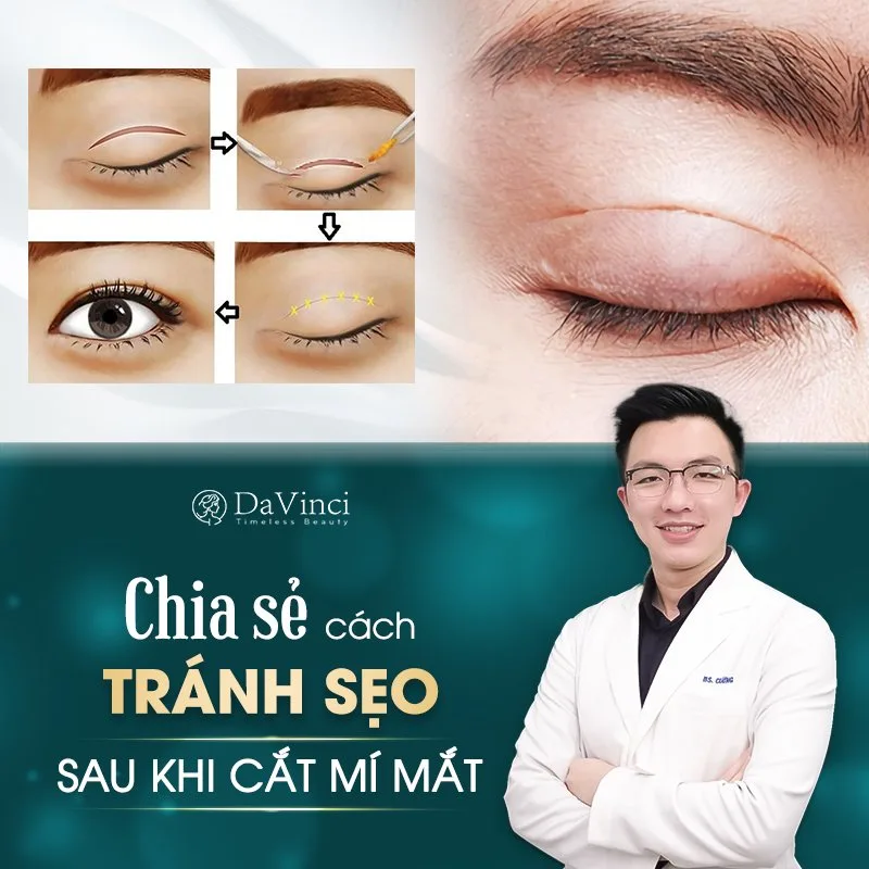 Cắt mí mắt có để lại sẹo không? Bí quyết tránh sẹo sau khi cắt mí hiệu quả Cắt mí mắt có để lại sẹo không? Bí quyết tránh sẹo sau khi cắt mí hiệu quả