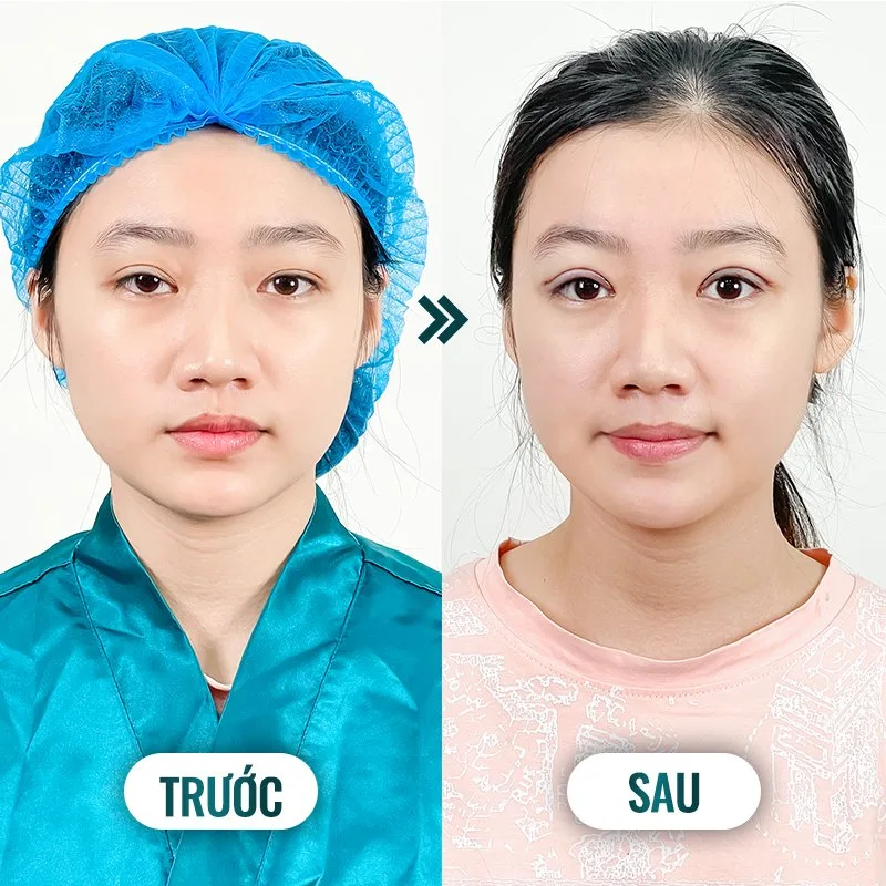 Cắt mí mắt có nguy hiểm không? 5 yếu tố an toàn cần lưu ý