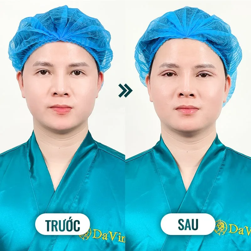 Cắt mí mắt nam có gì khác so với nữ giới? Giá bao nhiêu? Cắt mí mắt nam có gì khác so với nữ giới? Giá bao nhiêu?