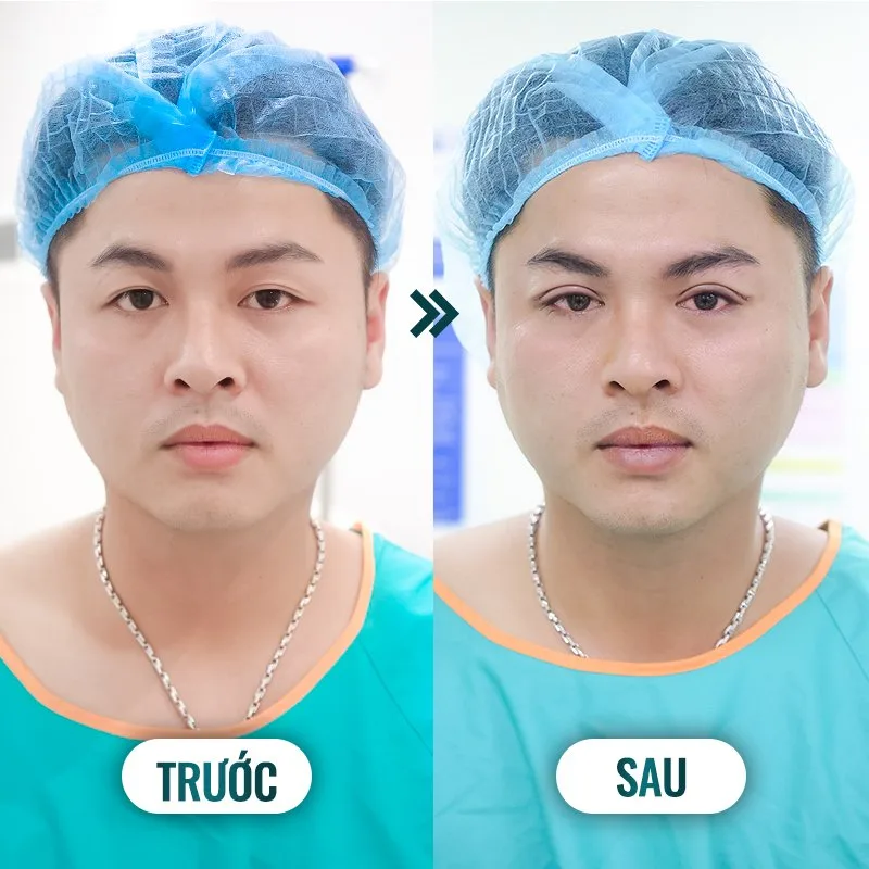 Cắt mí mắt nam có gì khác so với nữ giới? Giá bao nhiêu? Cắt mí mắt nam có gì khác so với nữ giới? Giá bao nhiêu?