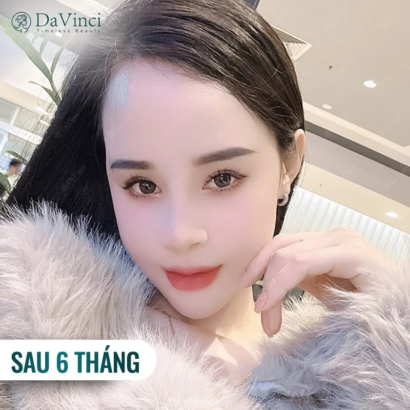 Cắt mí mắt có uống sữa được không? Cắt mí mắt có uống sữa được không?