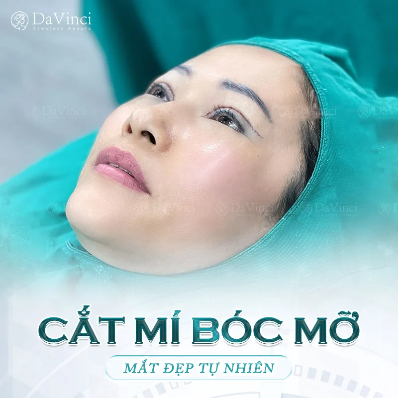 Có nên cắt mí bóc mỡ không? Cắt mí mắt ở đâu an toàn?
