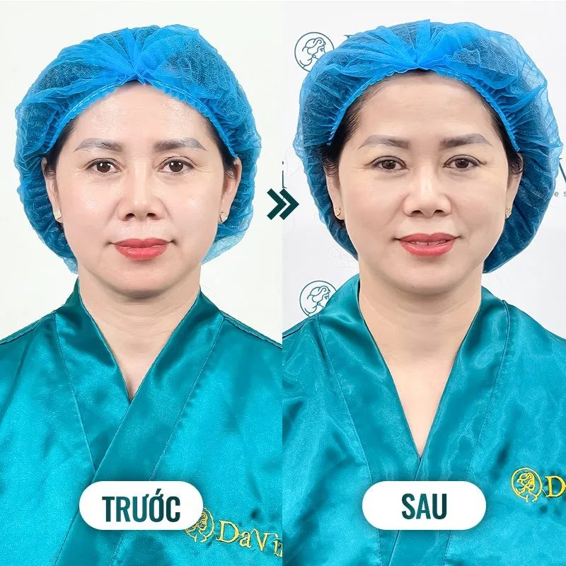 Có nên cắt mí bóc mỡ không? Cắt mí mắt ở đâu an toàn?