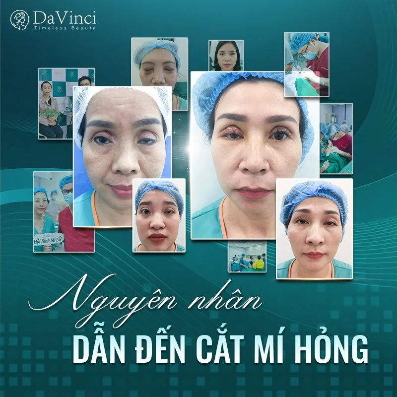 Biểu hiện cắt mí mắt bị hỏng là gì? Liệu cắt mí hỏng có sửa được không?
