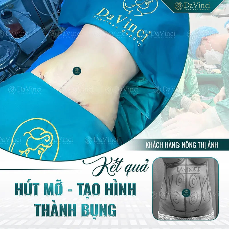 Đánh giá Review hút mỡ bụng tại thẩm mỹ Davinci mới nhất. Đánh giá Review hút mỡ bụng tại thẩm mỹ Davinci mới nhất.
