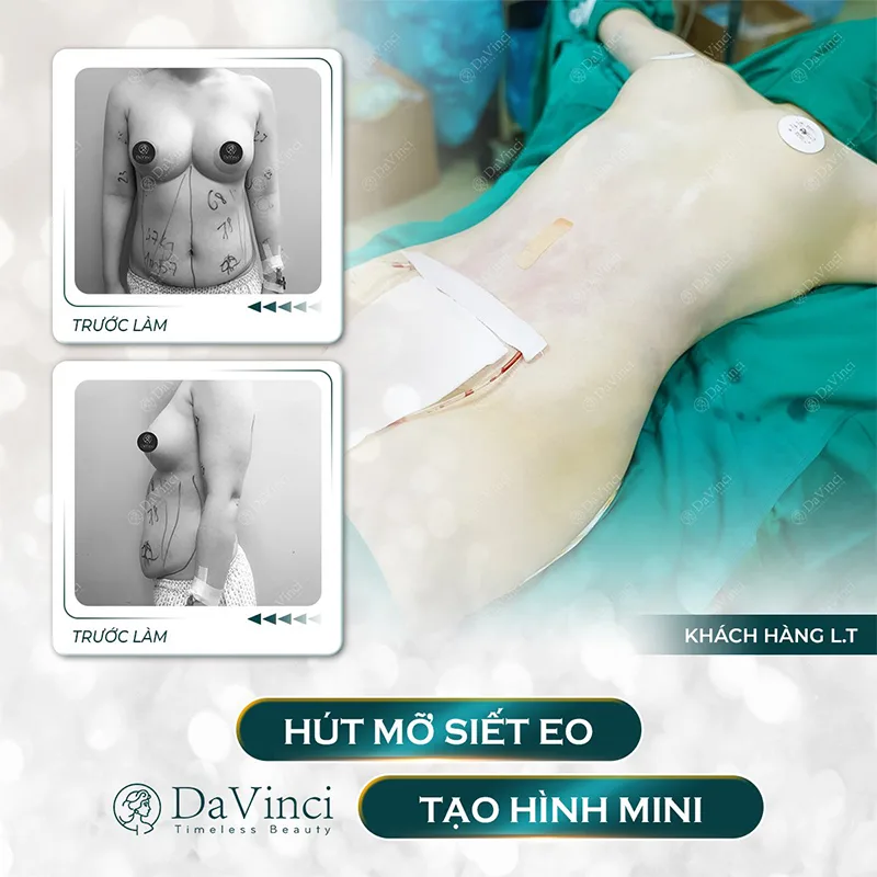 Đánh giá Review hút mỡ bụng tại thẩm mỹ Davinci mới nhất. Đánh giá Review hút mỡ bụng tại thẩm mỹ Davinci mới nhất.
