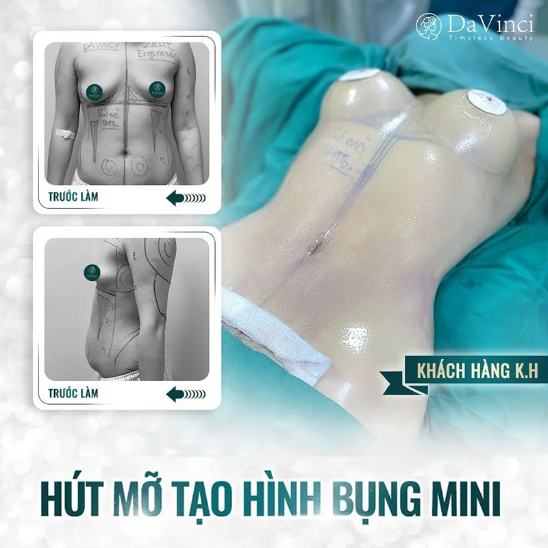 Đánh giá Review hút mỡ bụng tại thẩm mỹ Davinci mới nhất. Đánh giá Review hút mỡ bụng tại thẩm mỹ Davinci mới nhất.