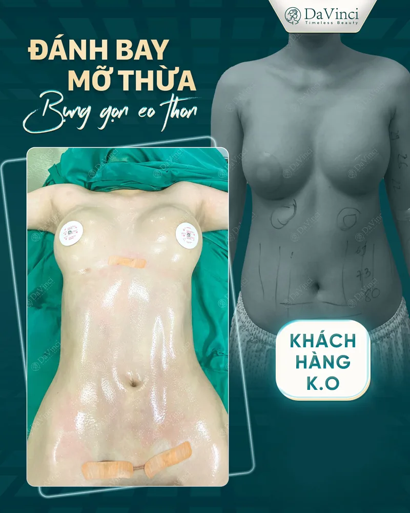 Đánh giá Review hút mỡ bụng tại thẩm mỹ Davinci mới nhất. Đánh giá Review hút mỡ bụng tại thẩm mỹ Davinci mới nhất.
