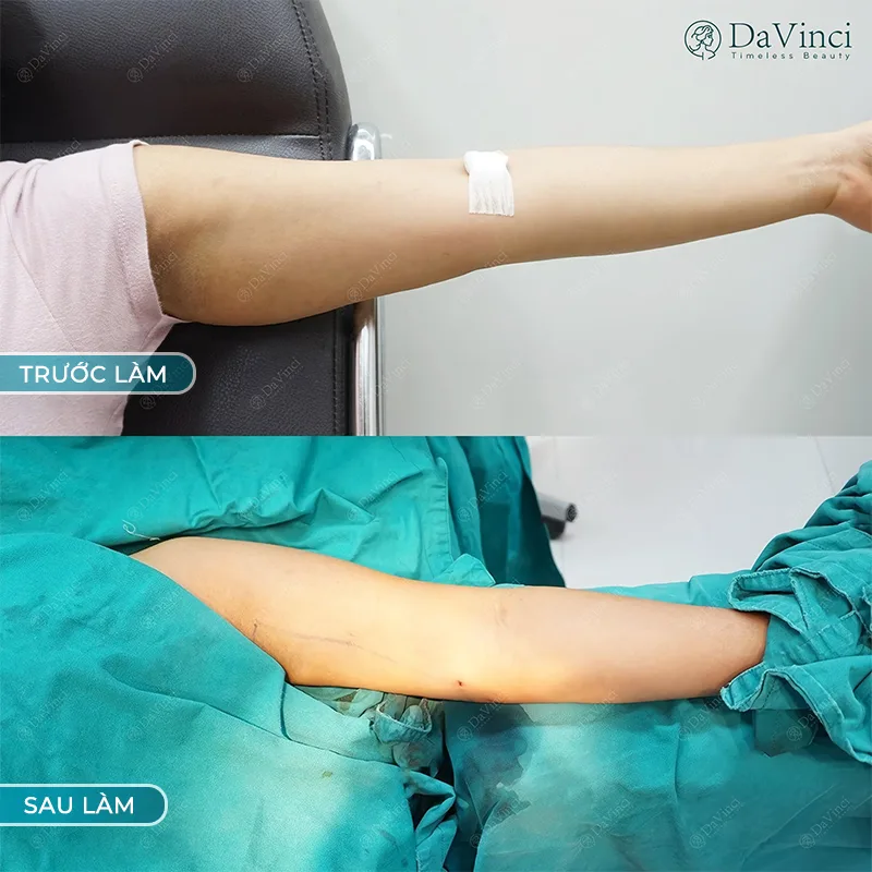 Hút mỡ đa tầng - Công nghệ hút mỡ tân tiến an toàn nhất.
