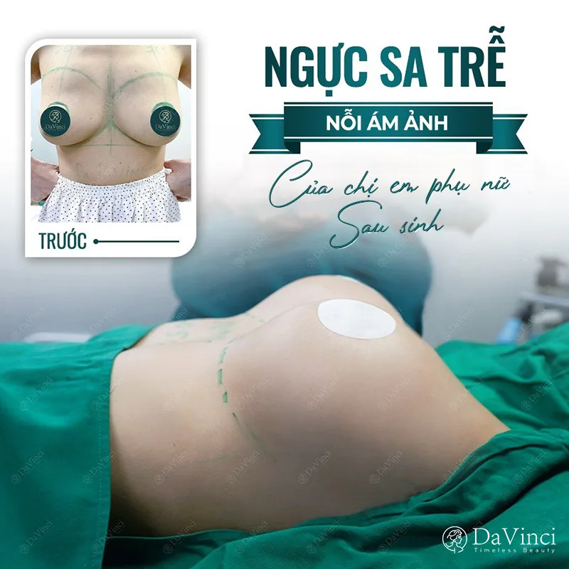 Nâng ngực chảy xệ sau sinh là gì? Giá bao nhiêu? Quy trình là gì? Nâng ngực chảy xệ sau sinh là gì? Giá bao nhiêu? Quy trình là gì?