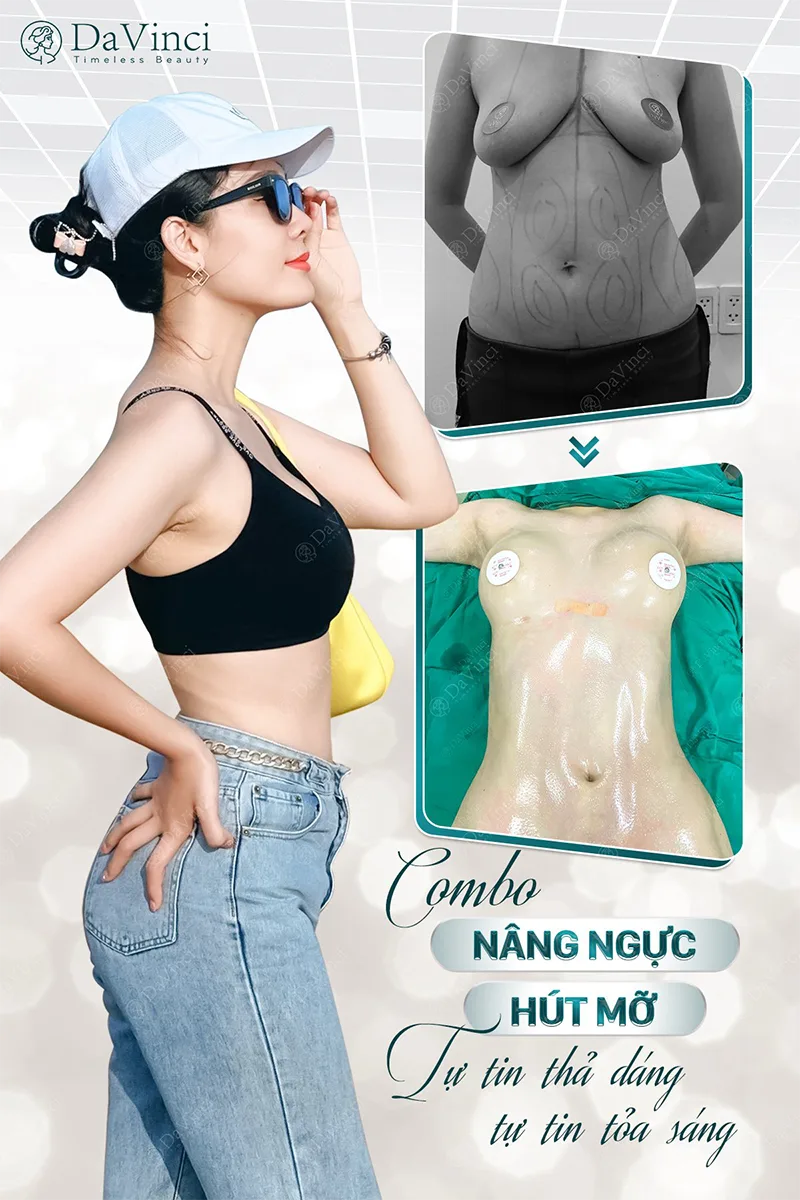 Nâng ngực chảy xệ sau sinh là gì? Giá bao nhiêu? Quy trình là gì? Nâng ngực chảy xệ sau sinh là gì? Giá bao nhiêu? Quy trình là gì?